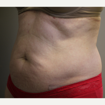 45-54 year old woman treated with SculpSure before 3015141