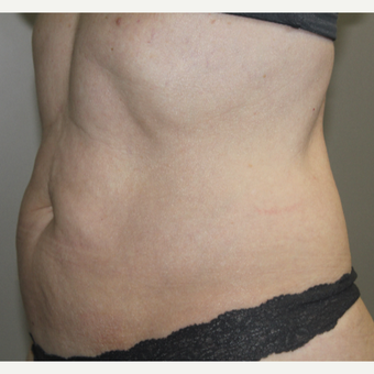 45-54 year old woman treated with SculpSure after 3015141