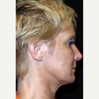 45-54 year old woman treated with ThermiTight before 2983820