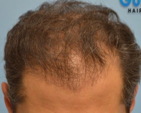 35-44 year old man treated with FUE Hair Transplant before 3604674