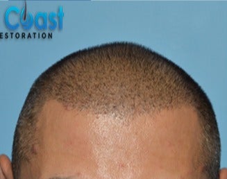 35-44 year old man treated with FUE Hair Transplant after 3604674