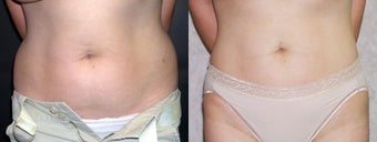 Liposuction of the Abdomen and Flanks before 336130