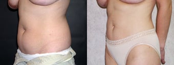 Liposuction of the Abdomen and Flanks 336130