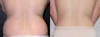 Liposuction of the Abdomen and Flanks after 336130