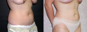 Liposuction of the Abdomen and Flanks 336130
