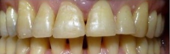 Fixing teeth that protrude using Braces after 3031536