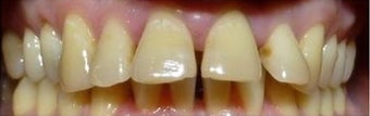 Fixing teeth that protrude using Braces before 3031536