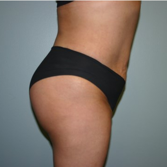 Brazilian Butt Lift after 3667518
