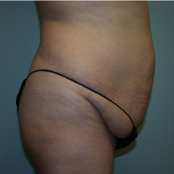 Brazilian Butt Lift before 3667518