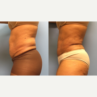 62 year old woman treated with Liposuction of the abdomen and waist after 3174525