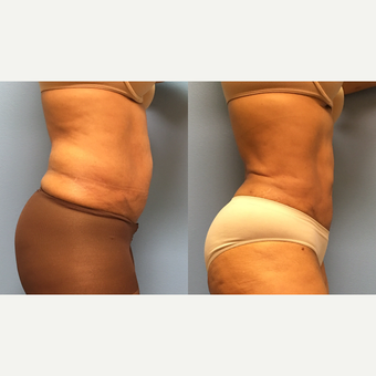 62 year old woman treated with Liposuction of the abdomen and waist before 3174525
