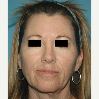 55-64 year old woman treated with Microneedling after 2882799