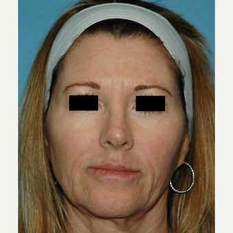 55-64 year old woman treated with Microneedling before 2882799