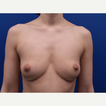 35-44 year old woman treated with Fat Transfer before 3522581