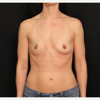 35-44 year old woman treated with Mentor Breast Implants before 2360711