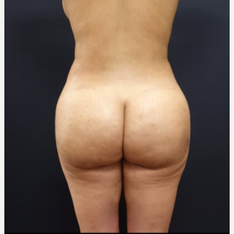 25-34 year old woman treated with Butt Lift after 3267047