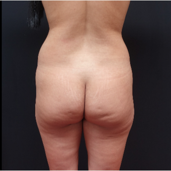 25-34 year old woman treated with Butt Lift before 3267047