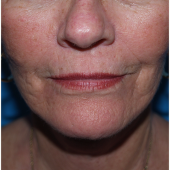 A former smoker with lines around her mouth after 3035899