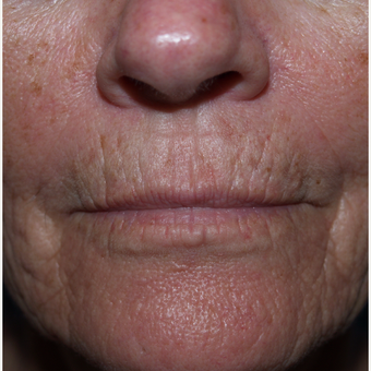 A former smoker with lines around her mouth before 3035899