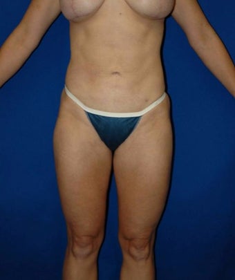 35-44 year old woman treated with SAFELipo after 3125911