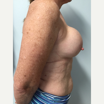 58 year old woman treated with Breast Implant Revision before 3585985