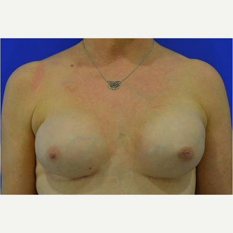 50 year old woman treated with nipple-sparing mastectomies and implant-based Breast Reconstruction after 3724407