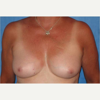50 year old woman treated with nipple-sparing mastectomies and implant-based Breast Reconstruction before 3724407