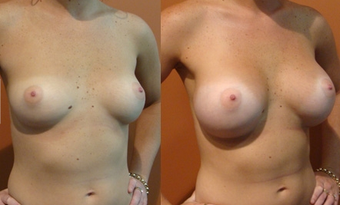 Breast Implants before 974268