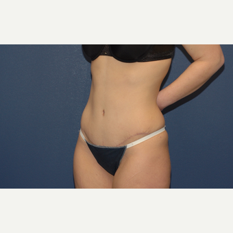 32 year old woman treated with Tummy Tuck after 3283195