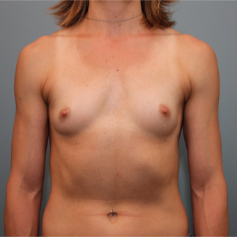 34 year old woman had Breast Augmentation with Inspira Breast Implants before 3390912