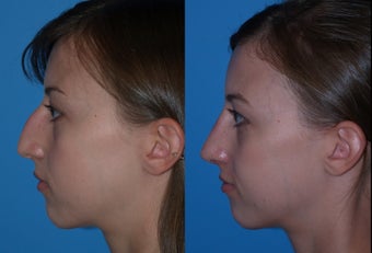 Rhinoplasty before 635983