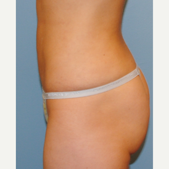 26 year old who had liposuction of her abdomen and flanks after 3142652