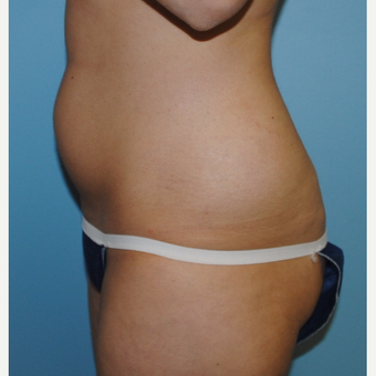 26 year old who had liposuction of her abdomen and flanks before 3142652