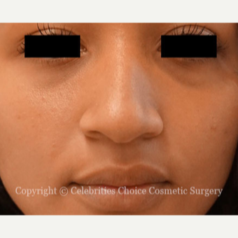 17 or under year old woman treated with Rhinoplasty before 3768649