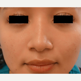 17 or under year old woman treated with Rhinoplasty after 3768649