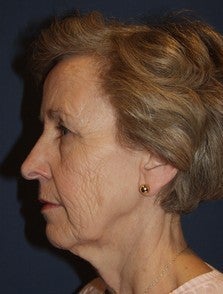 Eyelid Surgery, Face Lift/Minituck and Laser Resurfacing Patient before 969735