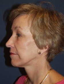 Eyelid Surgery, Face Lift/Minituck and Laser Resurfacing Patient after 969735