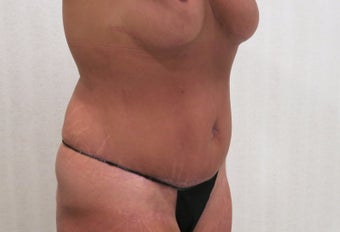 45-54 year old woman treated with Tummy Tuck after 2814146