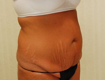 45-54 year old woman treated with Tummy Tuck before 2814146