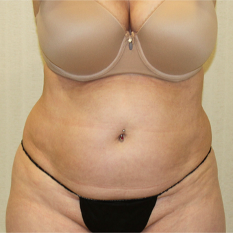 55-64 Year Old Woman Treated with Tummy Tuck to treat Excess Skin and Fat in Abdominal Region before 2988685