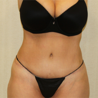 55-64 Year Old Woman Treated with Tummy Tuck to treat Excess Skin and Fat in Abdominal Region after 2988685