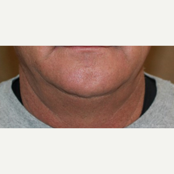 55-64 year old man treated with Kybella before 2787503