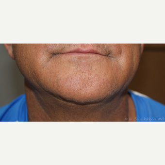 55-64 year old man treated with Kybella after 2787503