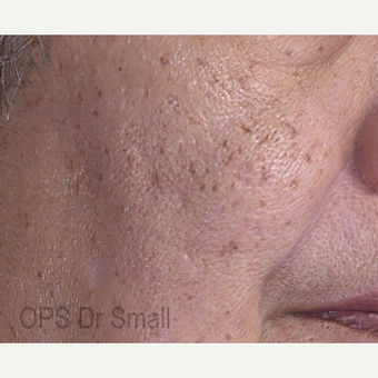 55-64 year old woman treated with Photofacial before 3305873