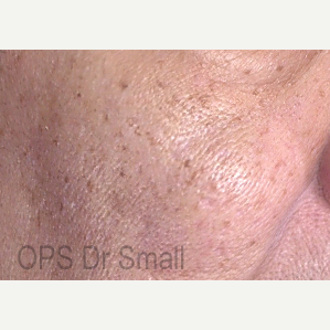 55-64 year old woman treated with Photofacial after 3305873