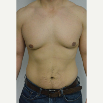 25-34 year old man treated with Male Breast Reduction before 3070560