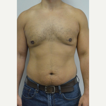 25-34 year old man treated with Male Breast Reduction after 3070560