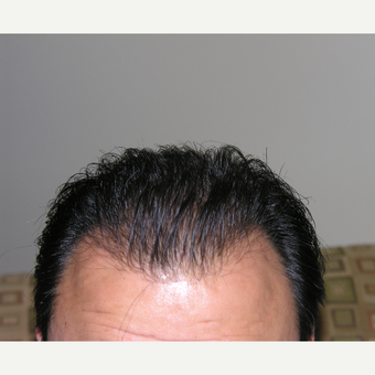 25-34 year old man treated with Hair Loss Treatment after 3506310