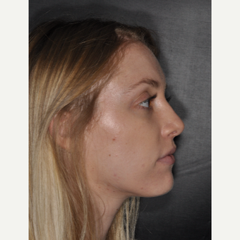 18-24 year old woman treated with Rhinoplasty 1 year post-op after 3499769