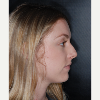 18-24 year old woman treated with Rhinoplasty 1 year post-op before 3499769